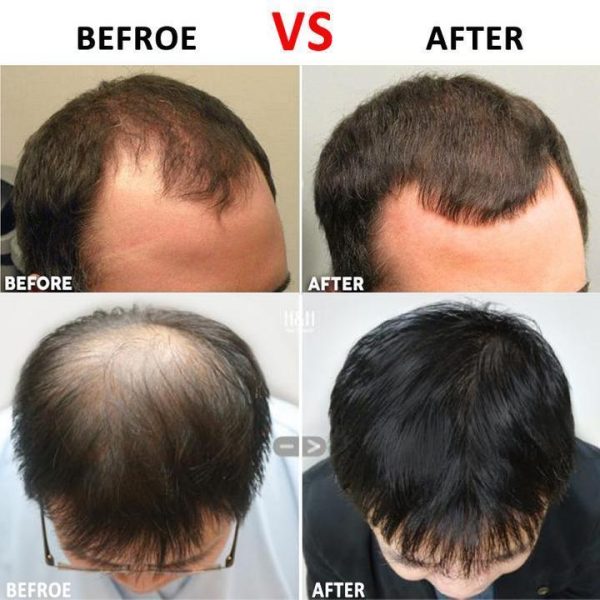 Hair Growth Roller - Image 3